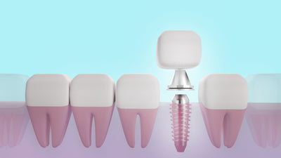 Dental Implants Thrive with New Probiotic Care