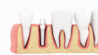 Unveiling OraTicx's Breakthrough in Dental Implant Health